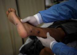 Un médico revisa a un paciente con llagas causadas por una infección de viruela del mono. Foto: ERNESTO BENAVIDES / AFP