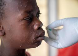 Un niño recibe tratamiento para mpox en el Centro de Salud de Munigi en Munigi, República Democrática del Congo, 19 de agosto de 2024.