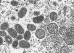 Esta imagen proporcionada por los Centros para el Control y la Prevención de Enfermedades (CDC), tomada con un microscopio electrónico, muestra un virión de la viruela del mono.