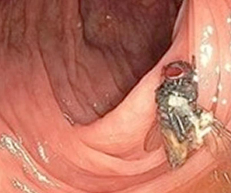 $!La mosca atrapada en el intestino grueso del hombre.