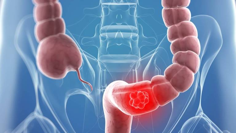 Avances para mejorar detección de cáncer de colon